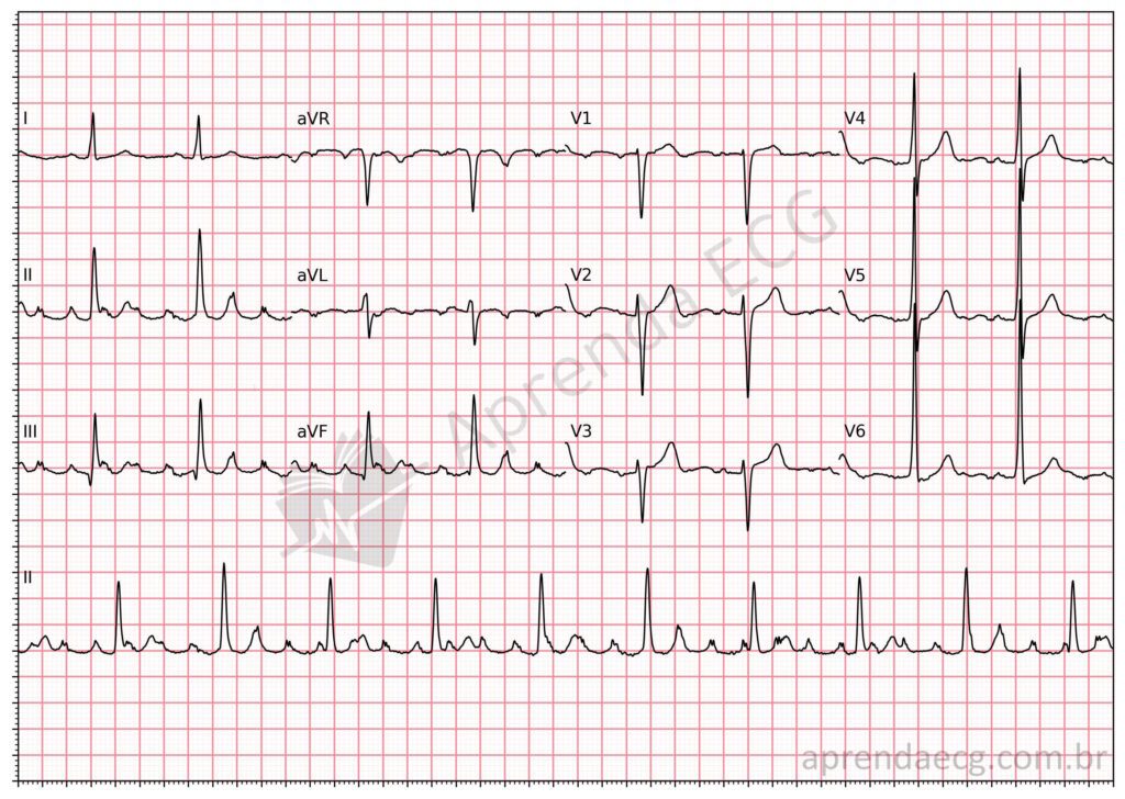 Eletrocardiograma com artefato