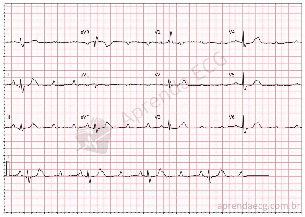 Eletrocardiograma com bloqueio atrioventricular avançado