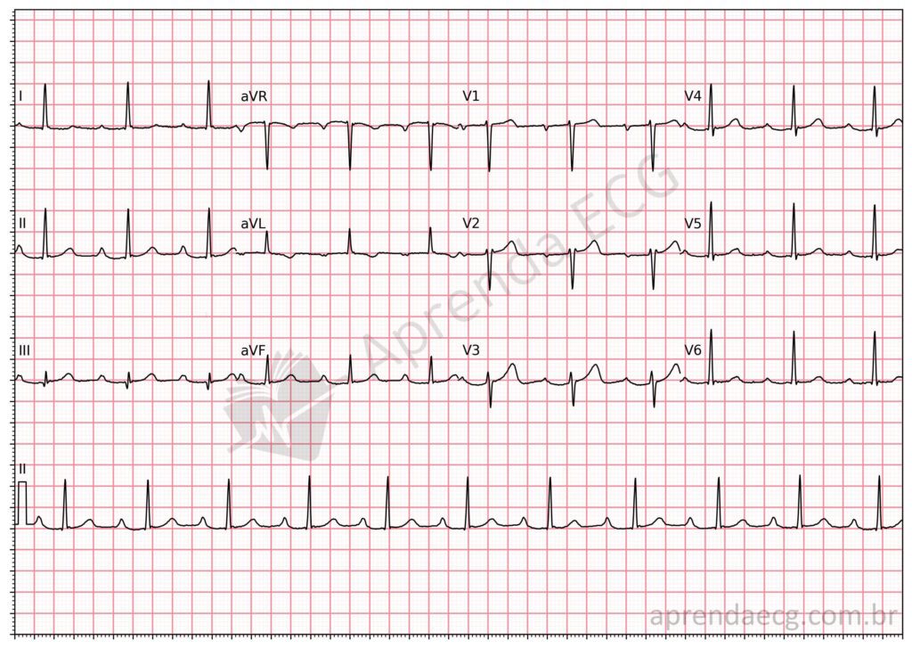 Eletrocardiograma com bloqueio atrioventricular de primeiro grau