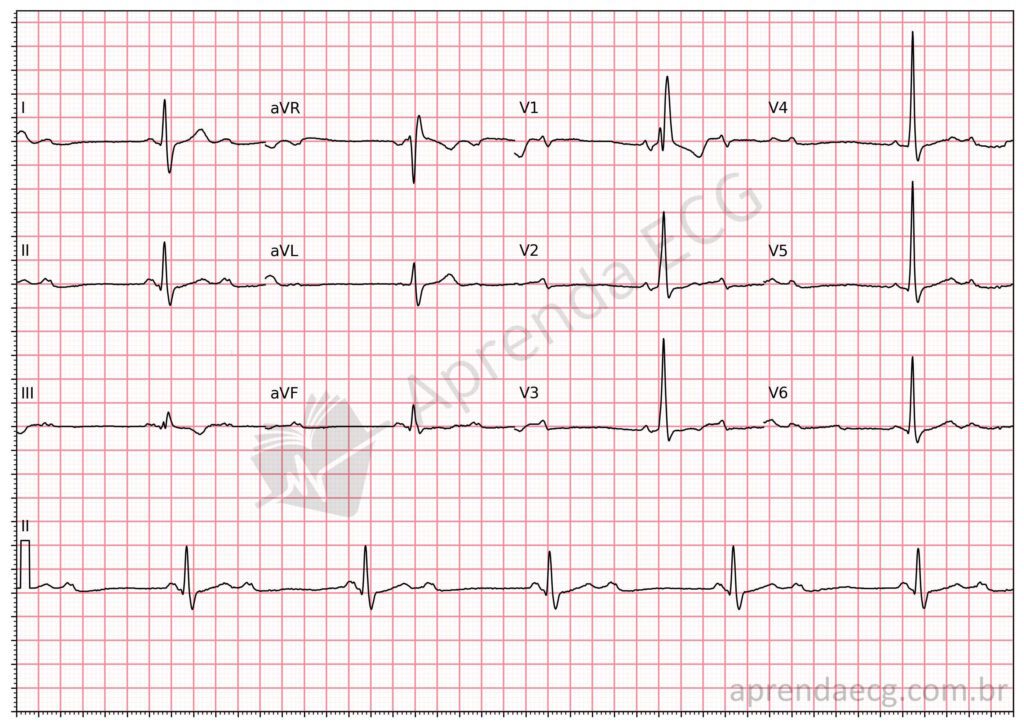 Eletrocardiograma com bloqueio atrioventricular 2:1