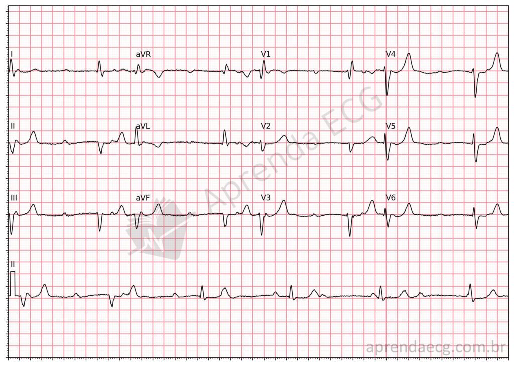 Eletrocardiograma com bloqueio atrioventricular de terceiro grau ou total (BAVT)