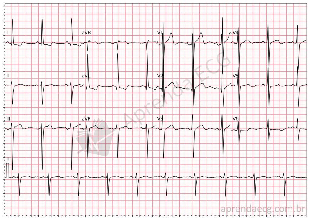 Eletrocardiograma com bloqueio divisional anterossuperior (BDAS)