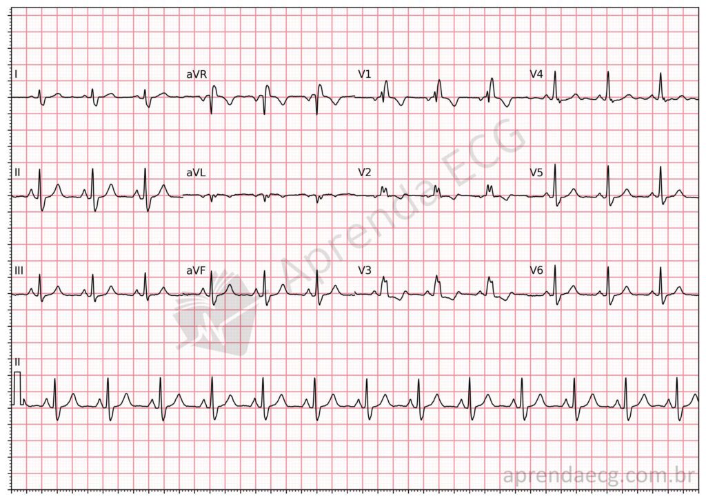 Eletrocardiograma com bloqueio de ramo direito