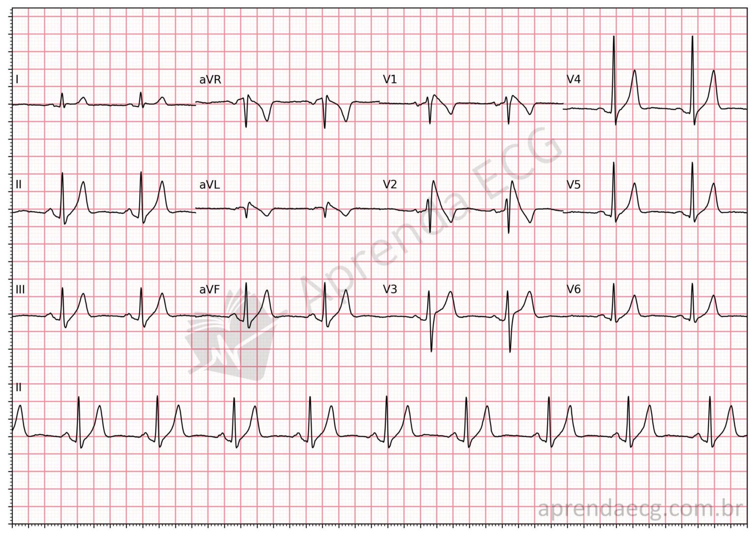 Síndrome de Brugada - Aprenda ECG | Doctor Quest | Doctor Quest