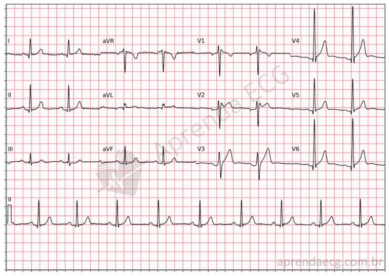 Síndrome de Brugada - Aprenda ECG