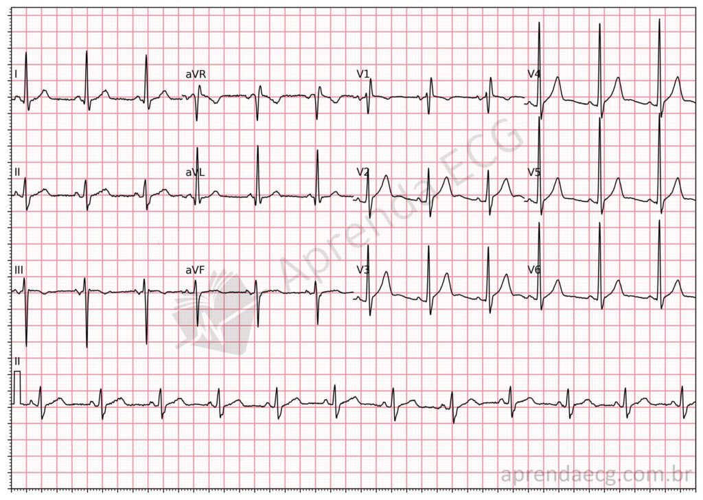 Eletrocardiograma com distúrbio de condução do ramo direito