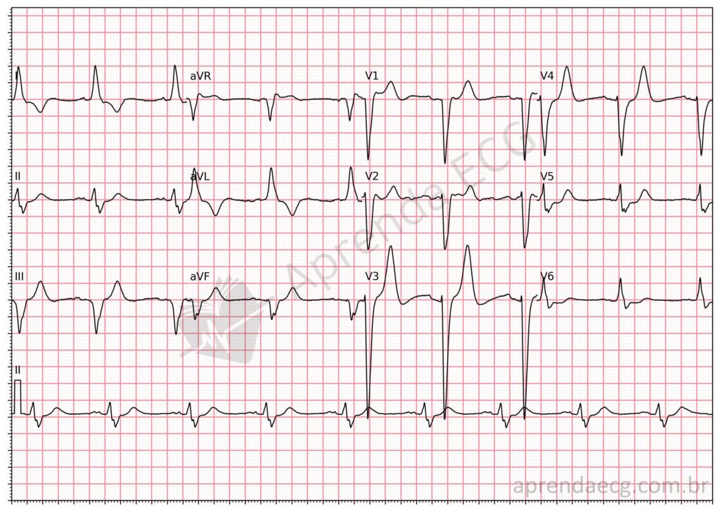 Eletrocardiograma com bloqueio periférico intraventricular