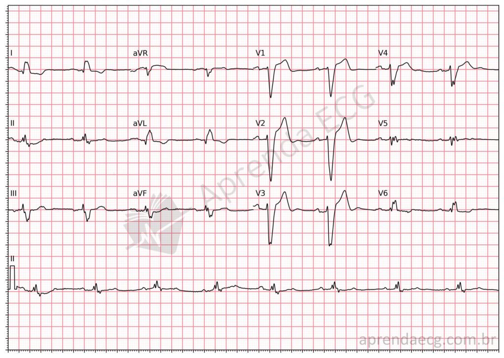 Eletrocardiograma com bloqueio de ramo esquerdo e fragmentação do QRS