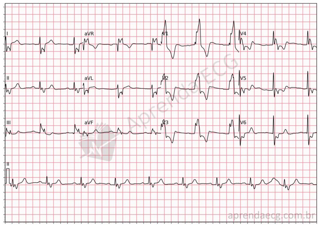 Eletrocardiograma com bloqueio de ramo direito e fragmentação do QRS