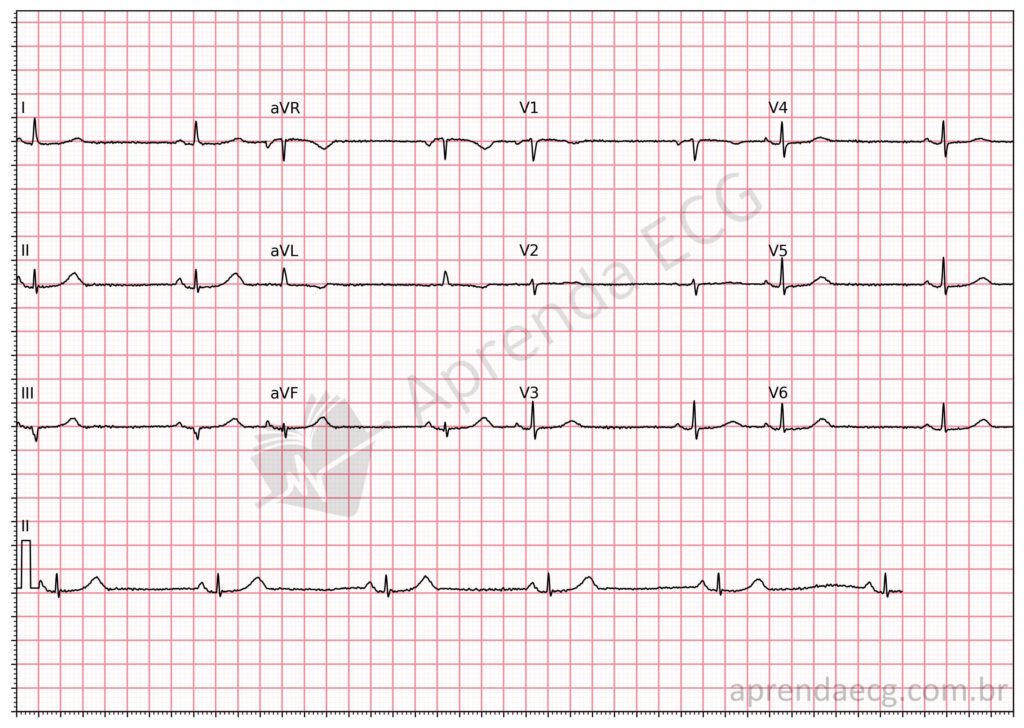 Eletrocardiograma no hipotireoidismo