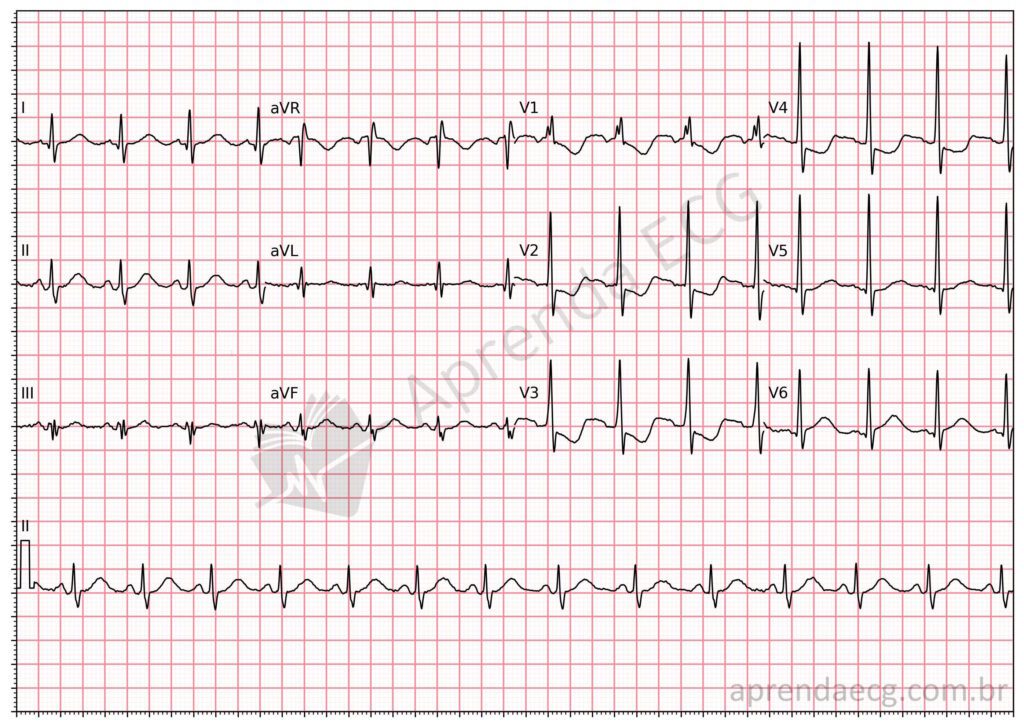 Eletrocardiograma com infradesnivelamento de V1 a V3