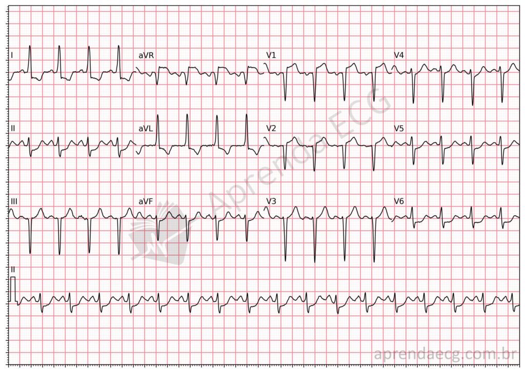 Eletrocardiograma com isquemia circunferencial