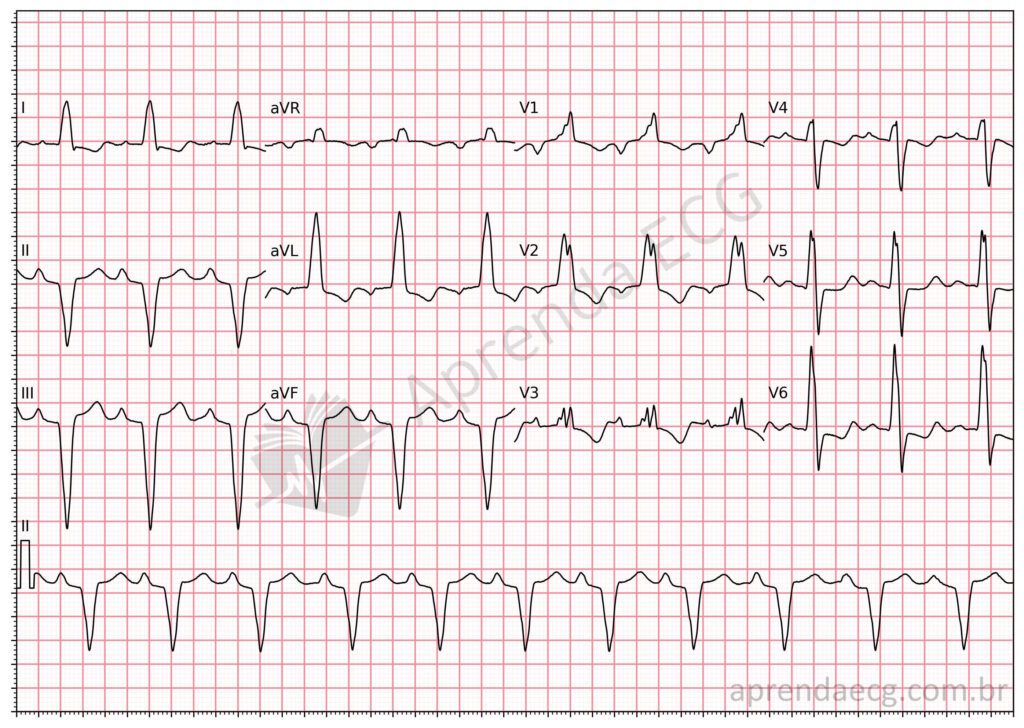 Eletrocardiograma com bloqueio de ramo mascarado