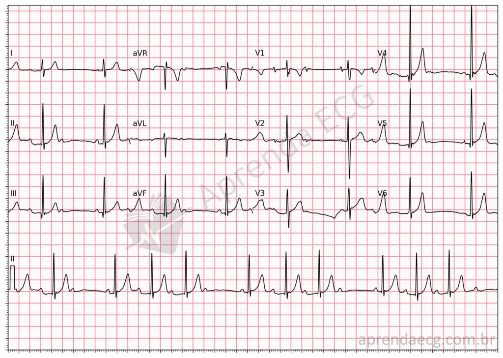 Eletrocardiograma com bloqueio atrioventricular de segundo grau mobitz 1