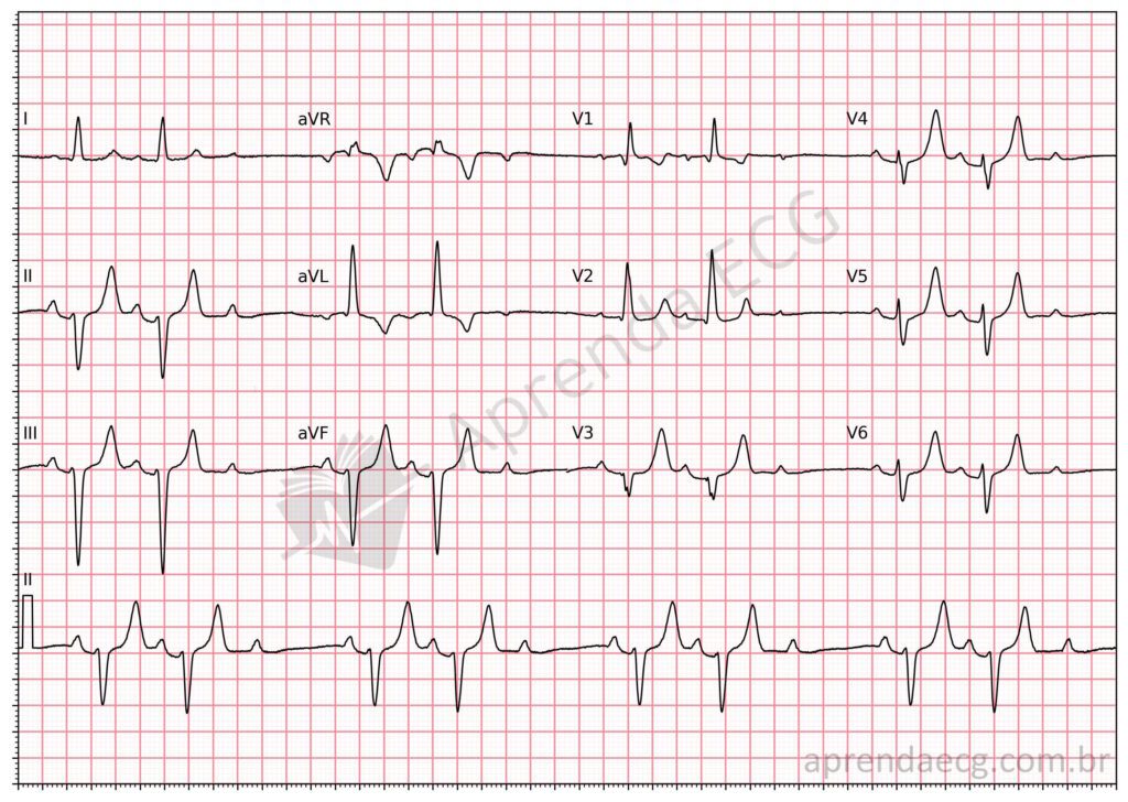 Eletrocardiograma com bloqueio atrioventricular de segundo grau mobitz 2