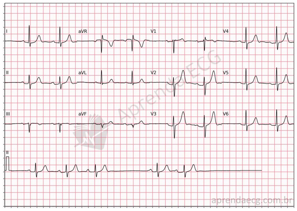 Eletrocardiograma com parada sinusal