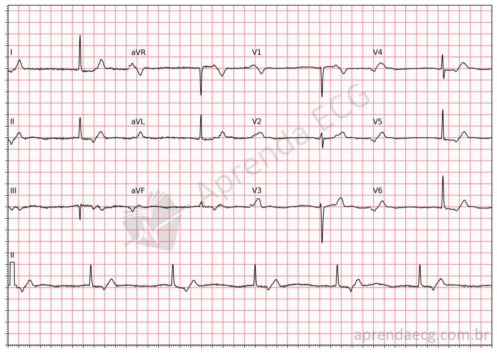 Eletrocardiogrma com ritmo de escape juncional