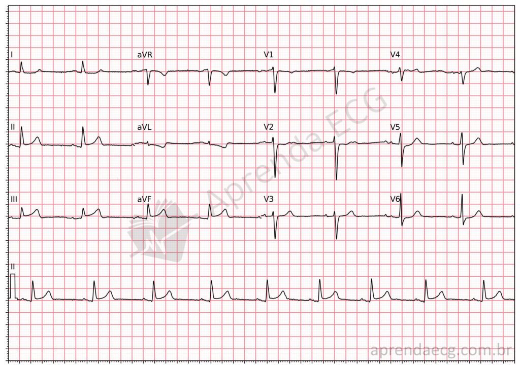 Eletrocardiograma com supradesnivelamento discreto do segmento ST