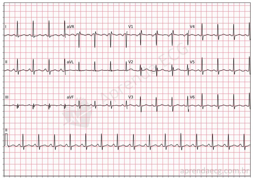 Taquicardia Sinusal Aprenda Ecg