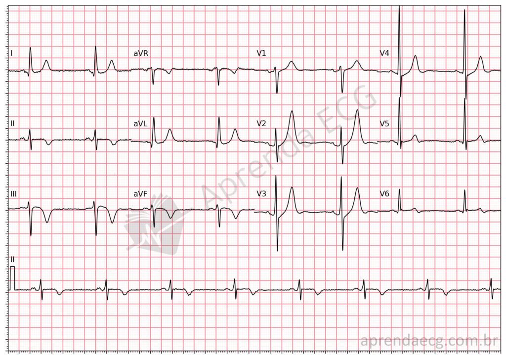 Eletrocardiograma com onda T hiperaguda