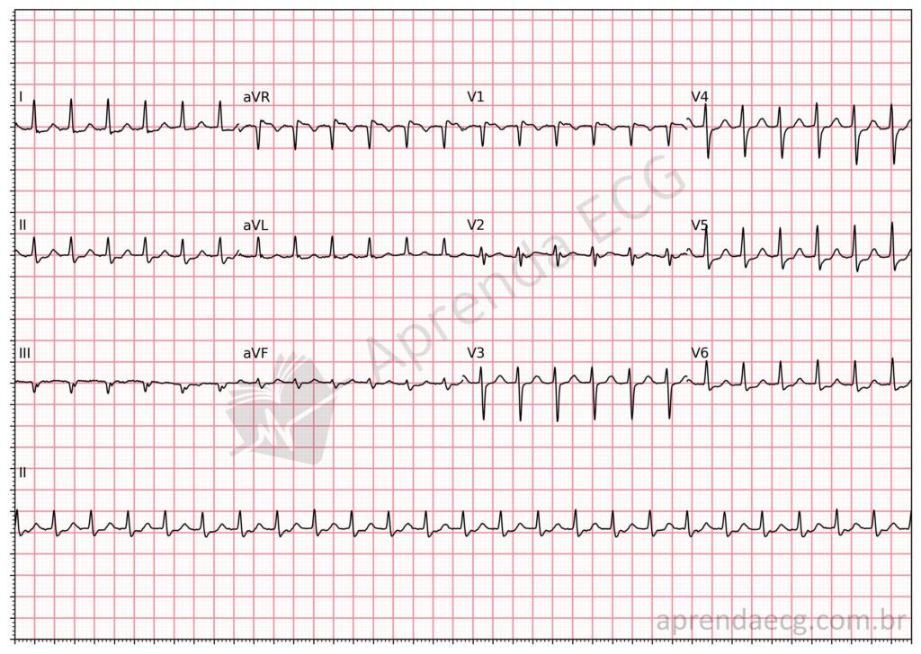 Eletrocardiograma com taquicardia por reentrada nodal