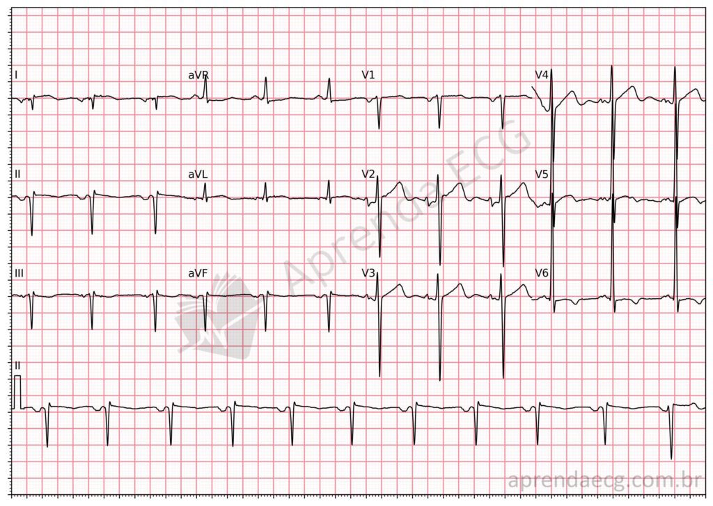 Eletrocardiograma com troca de eletrodos