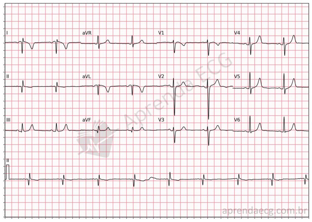 Eletrocardiograma com troca de eletrodos