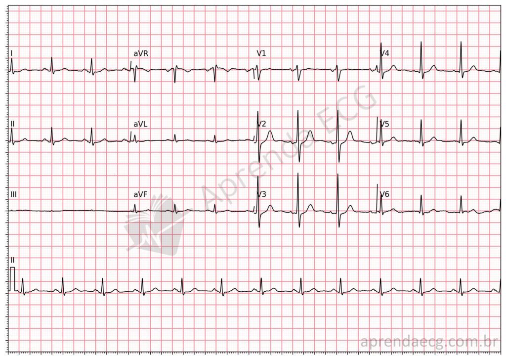 Eletrocardiograma com troca de eletrodos