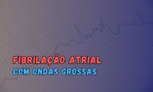 Leia mais sobre o artigo Ondas Grossas na Fibrilação Atrial: Um Marcador de Sucesso na Cardioversão Elétrica?