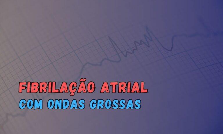 Leia mais sobre o artigo Ondas Grossas na Fibrilação Atrial: Um Marcador de Sucesso na Cardioversão Elétrica?