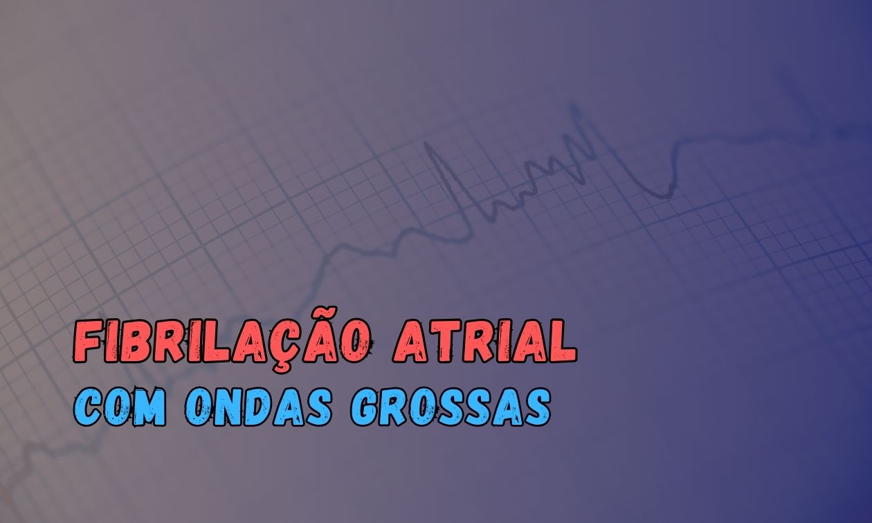 No momento, você está visualizando Ondas Grossas na Fibrilação Atrial: Um Marcador de Sucesso na Cardioversão Elétrica?