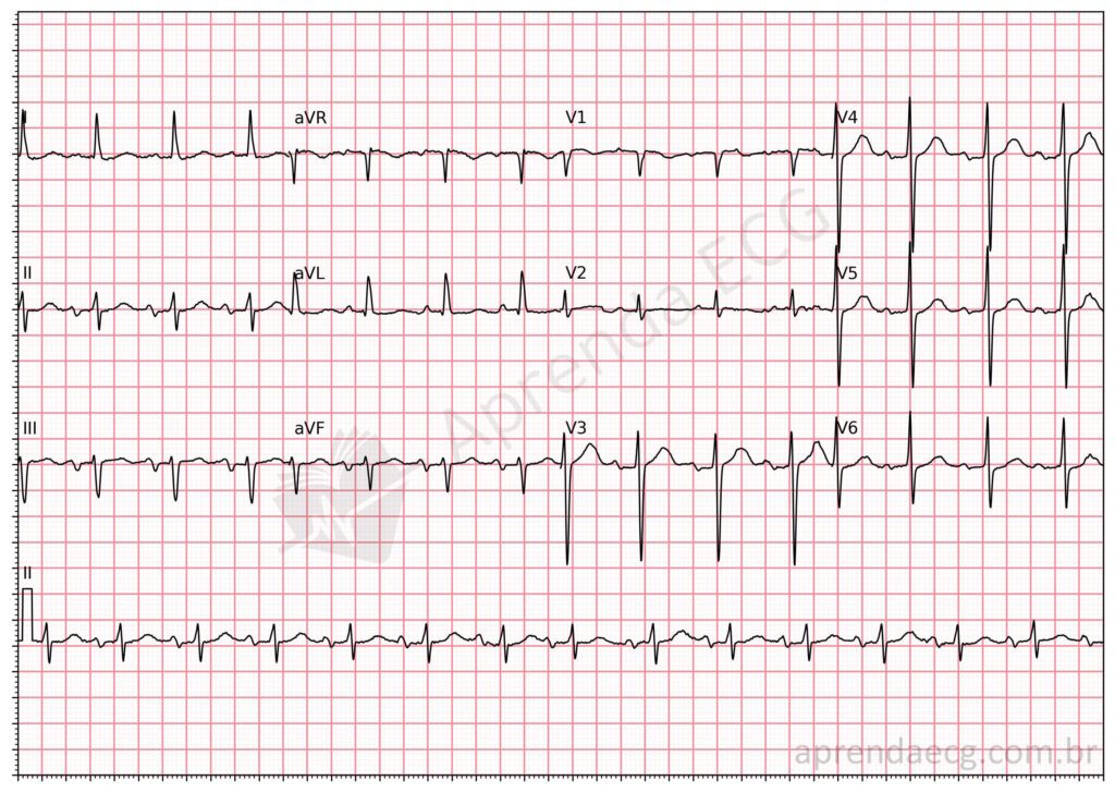 Eletrocardiograma com bloqueio interatrial avançado