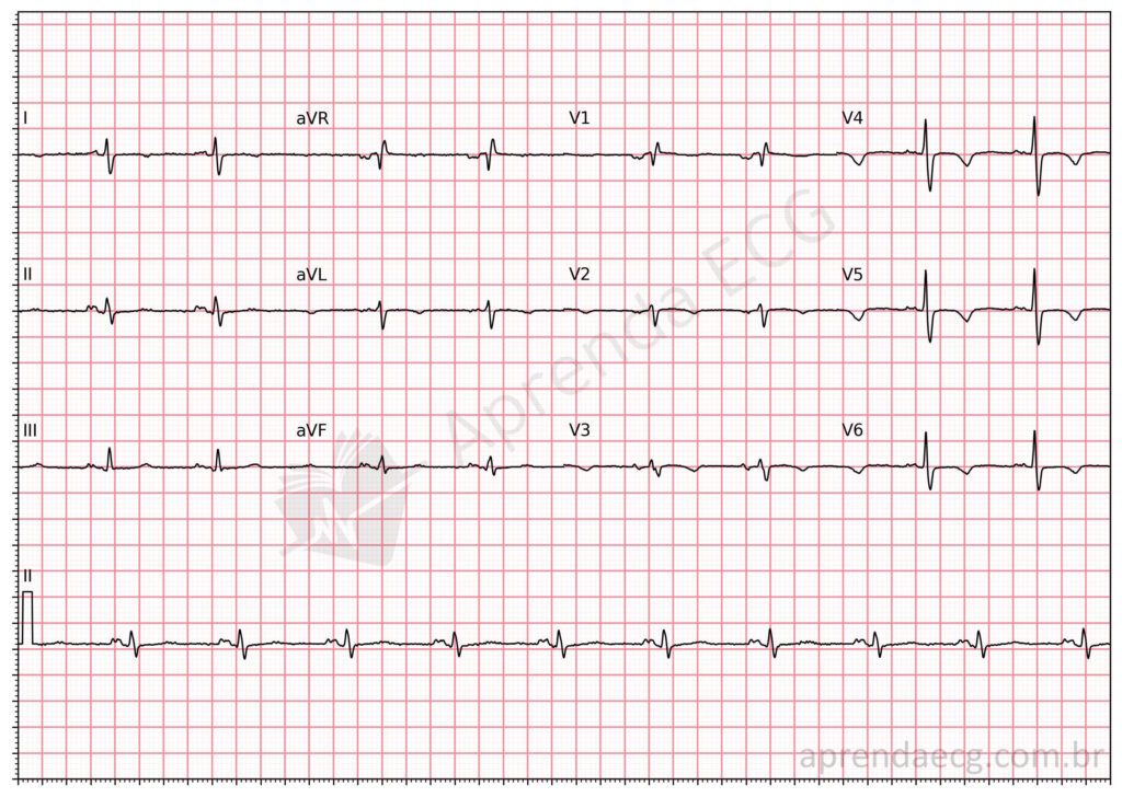 Eletrocardiograma com bloqueio interatrial parcial