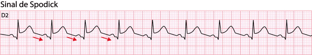 Traçado eletrocardiográfico representando o sinal de Spodick na pericardite aguda