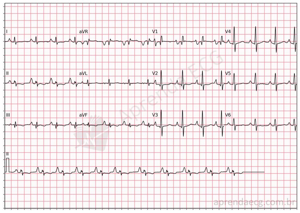 Eletrocardiograma de sobrecarga biatrial, com critérios tanto para sobrecarga atrial esquerda, quanto sobrecarga atrial direita.