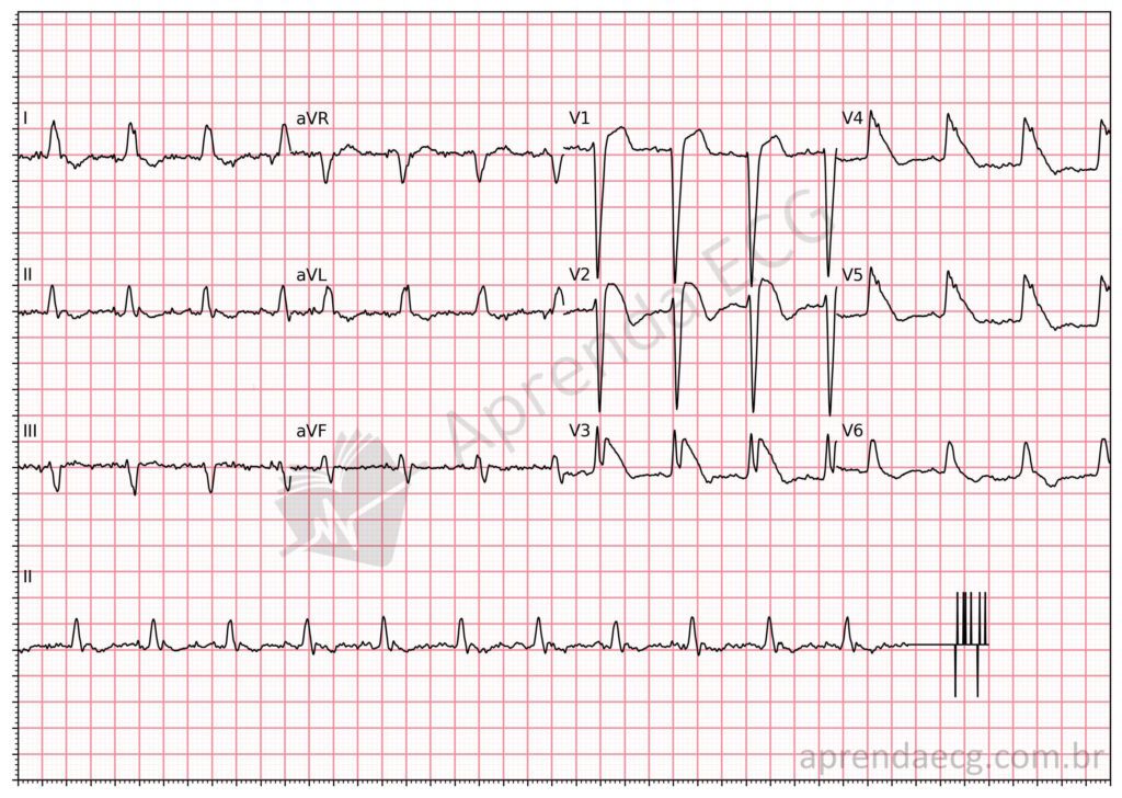 Eletrocardiograma com sinal da barbatana de tubarão