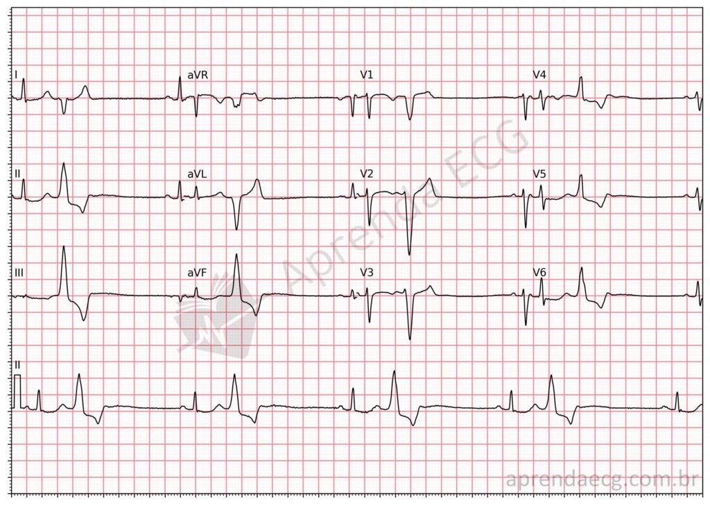 Eletrocardiograma com extrassístoles ventriculares (bigeminismo ventricular)