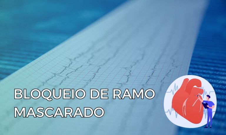 Leia mais sobre o artigo Bloqueio de Ramo Mascarado: Um Diagnóstico Eletrocardiográfico que Merece Atenção