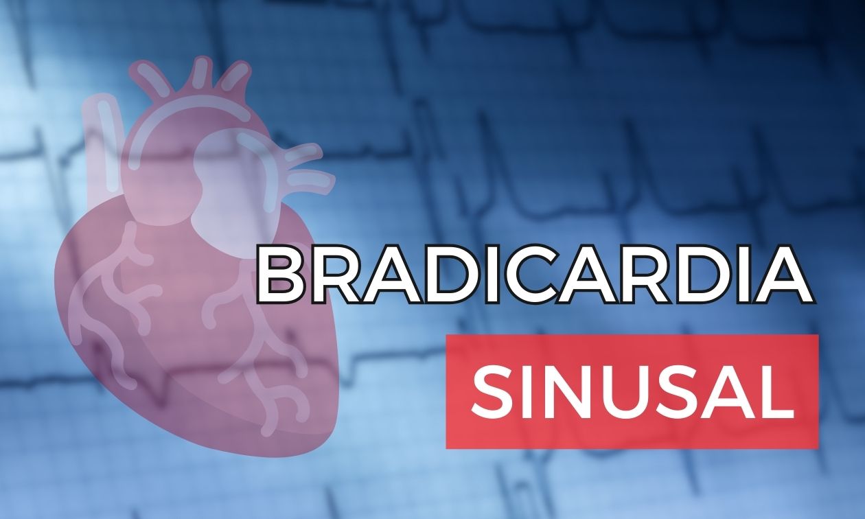 No momento, você está visualizando Bradicardia Sinusal: Causas, Fisiopatologia e Critérios Eletrocardiográficos