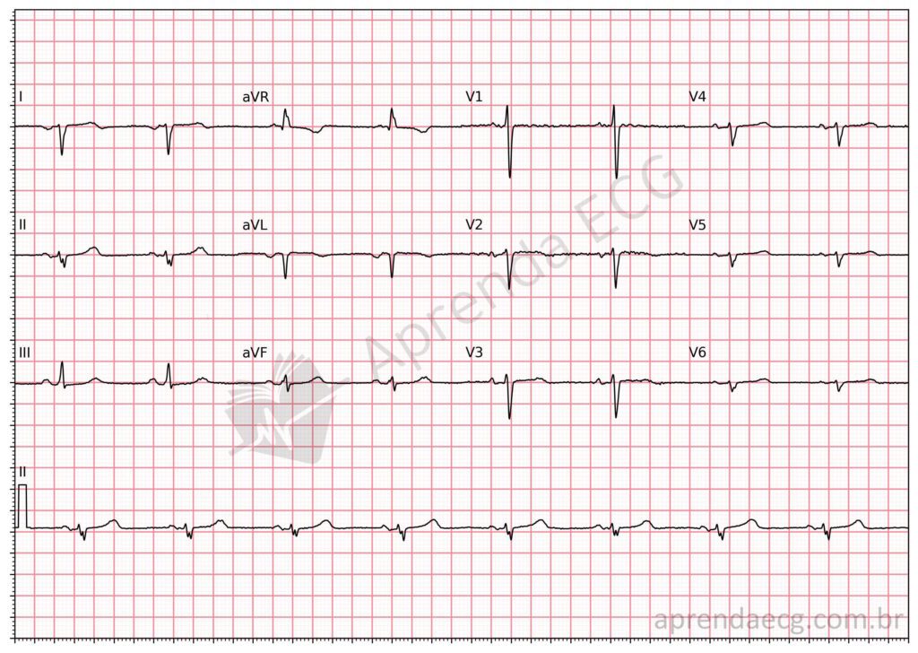 Eletrocardiograma com dextrocardia