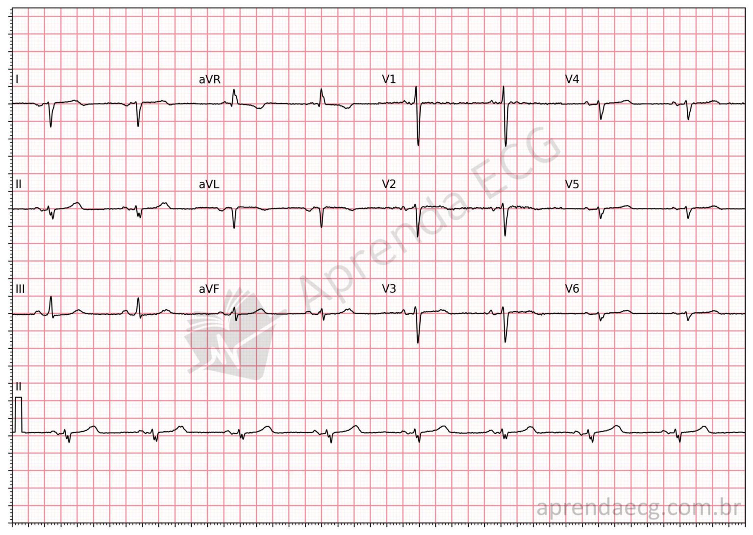 Onda R Ecg 10 Causas de Onda R Alta em V1 e V2 - Aprenda ECG