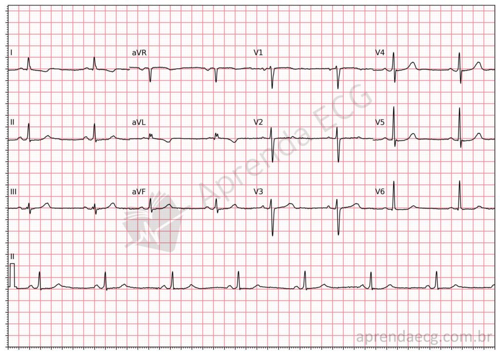 Eletrocardiograma com dextrocardia