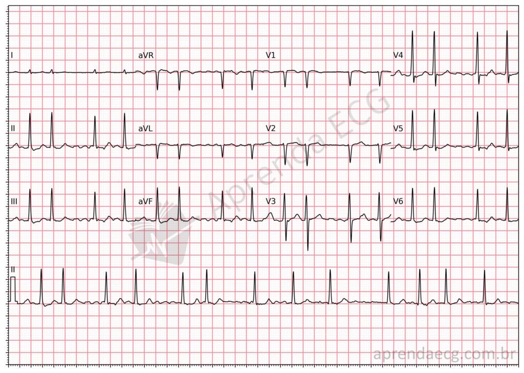 Eletrocardiograma de fibrilação atrial