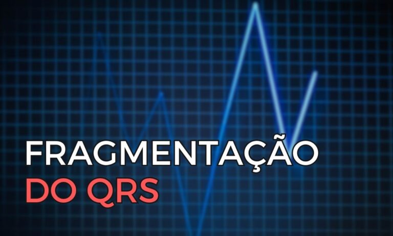 Leia mais sobre o artigo Fragmentação do QRS: Um marcador subestimado no eletrocardiograma