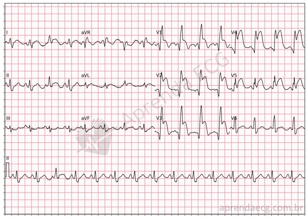 Eletrocardiograma com infarto e bloqueio de ramo direito