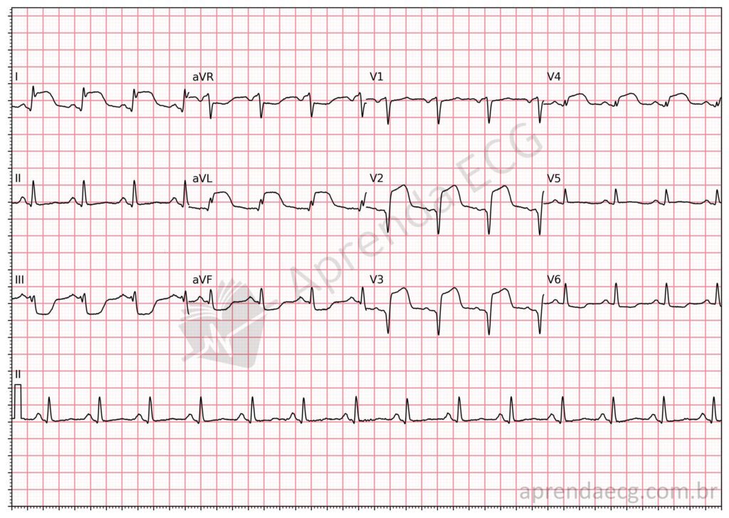 Eletrocardiograma com padrão de supradesnivelamento do segmento ST em lápide