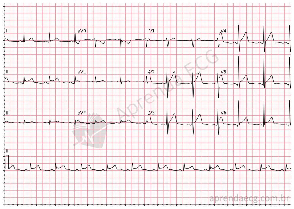 Eletrocardiograma com pericardite aguda