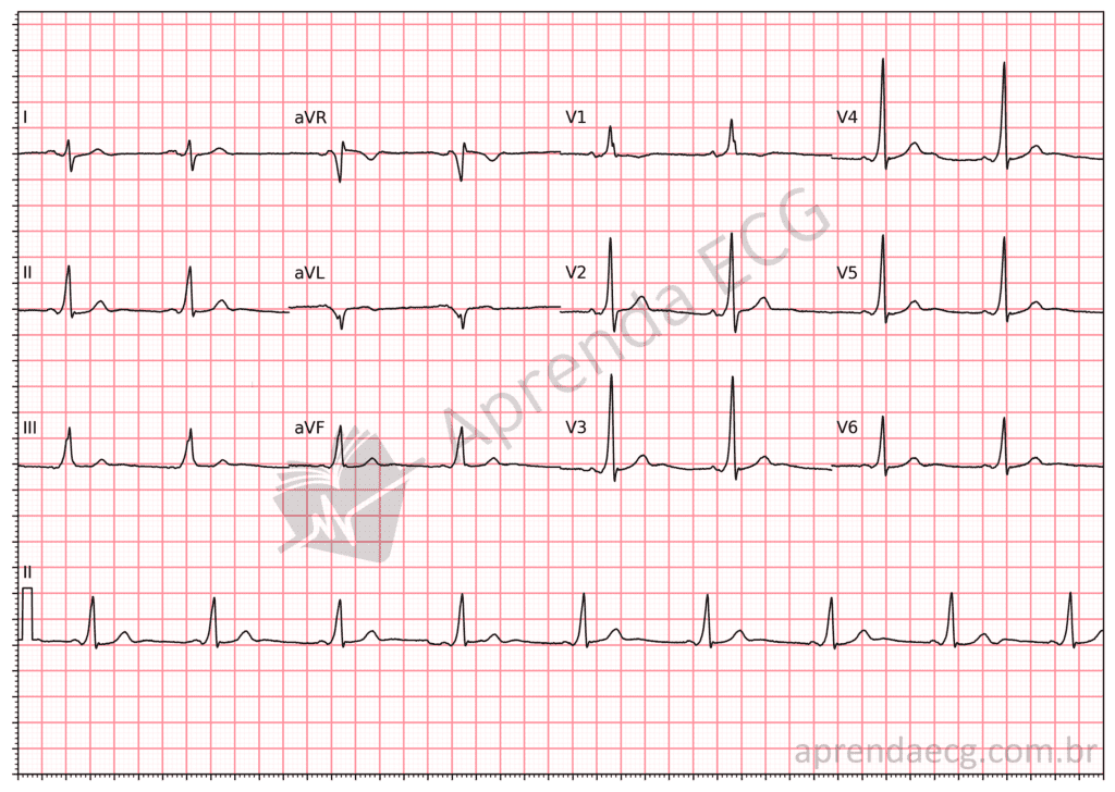 Eletrocardiograma com pré-excitação ventricular e onda delta