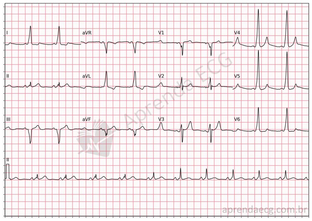 Eletrocardiograma com pré-excitação ventricular e onda delta