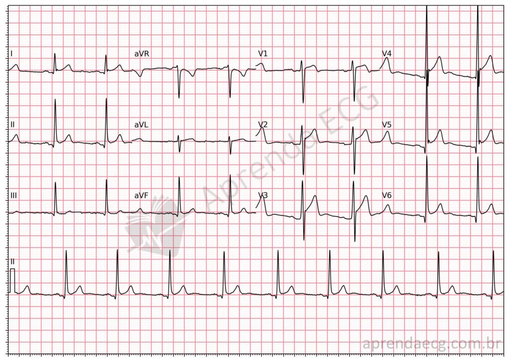 Eletrocardiograma com repolarização precoce